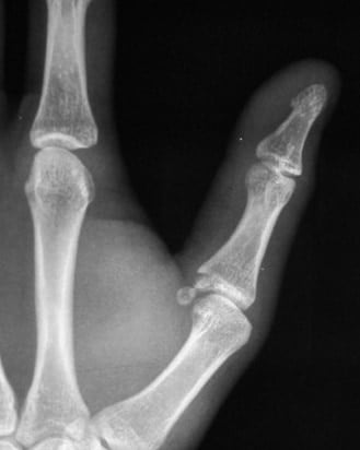 Gamekeepers avulsion